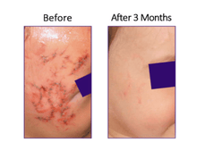 Load image into Gallery viewer, DrFreund Skincare scar treatments Biocorneum® Advanced Scar Treatment with Silishield Patented Crosslinking Silicone with SPF30 Sunscreen Biocorneum Advanced Scar Treatment with SPF 30 Sunscreen
